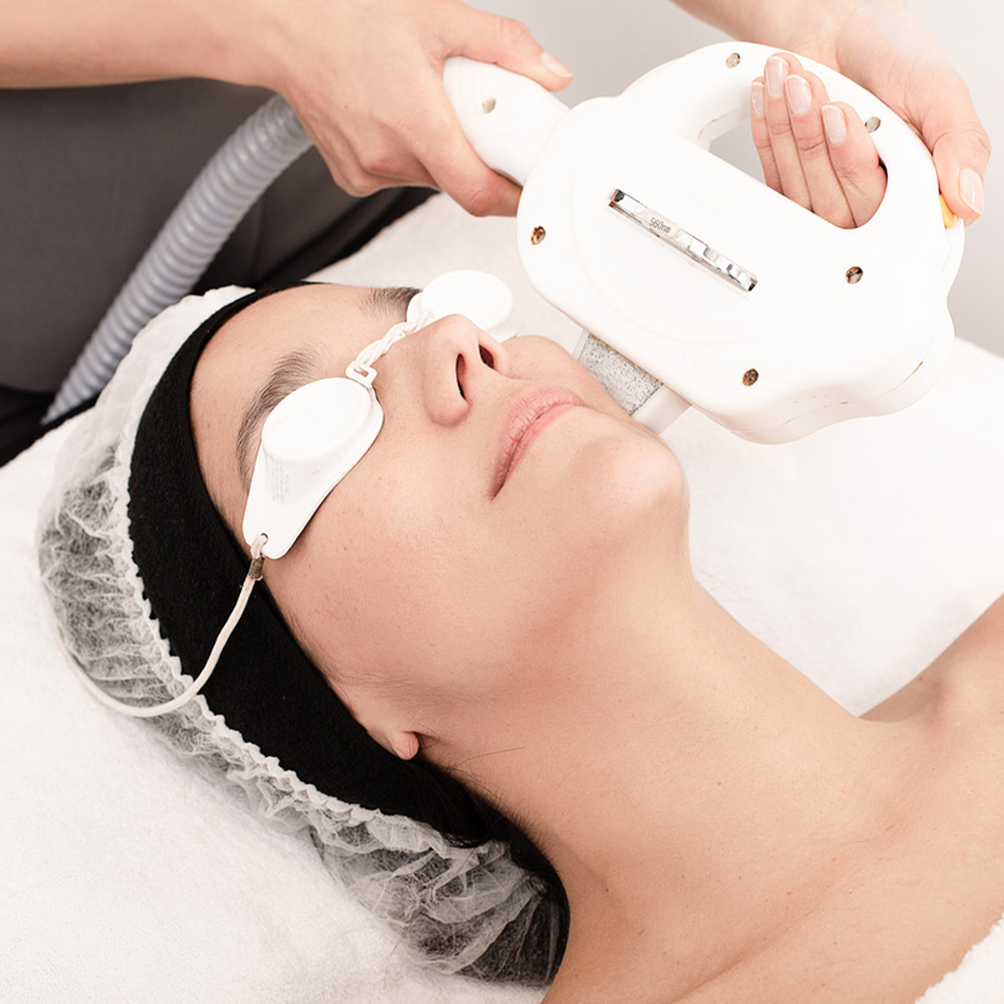 Fotorejuvenecimiento con IPL Cara Y Cuello