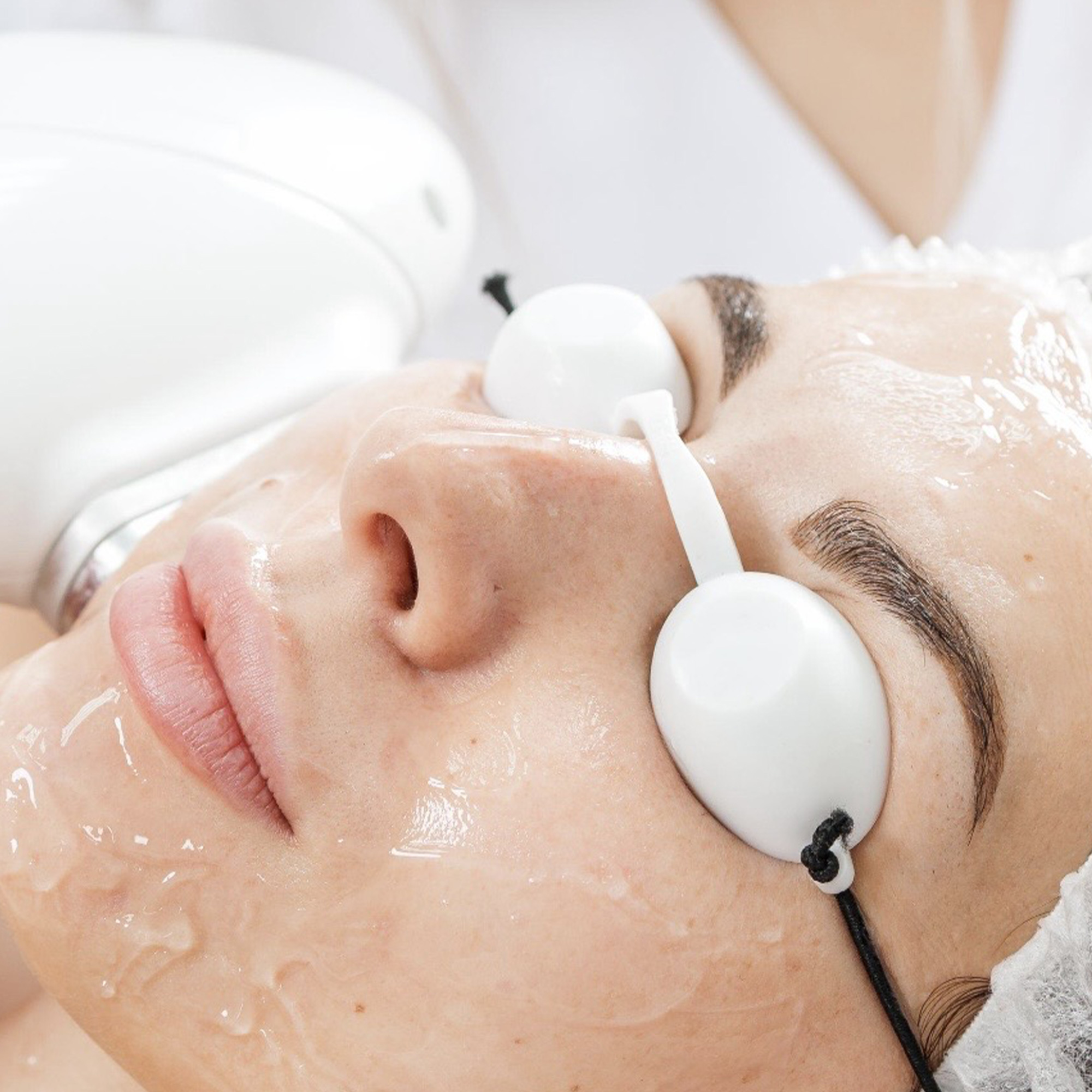Fotorejuvenecimiento con IPL Facial