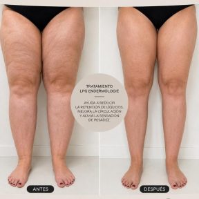 Tratamiento LPG Endermologie para Lipedema en Piernas